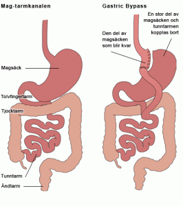 gastric_bypass_1